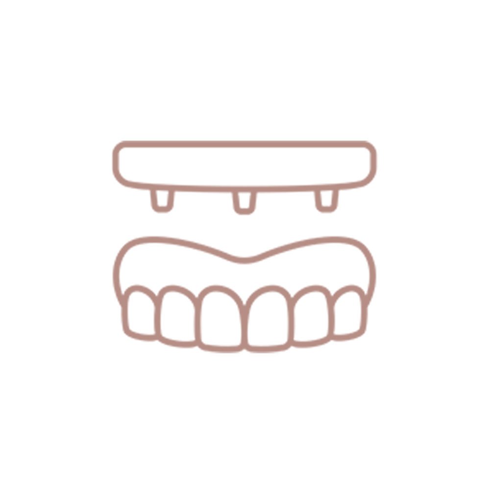 Procedimento em que a prótese ou coroa dentária é fixada no implante logo após a sua colocação, permitindo a função imediata da nova dentição.