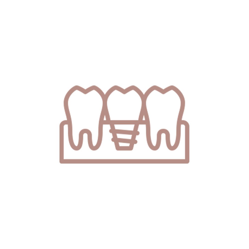 Procedimento que consiste na colocação de um implante dental para substituir um único dente ausente.