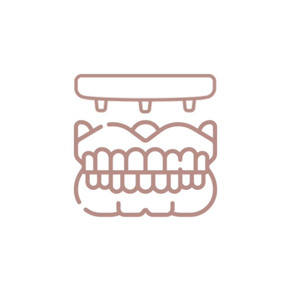 Prótese fixa implantossuportada usada para substituir todos os dentes de uma arcada, proporcionando estabilidade e estética.